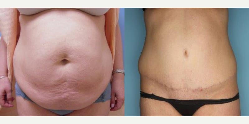 Mommy Makeover procedure image