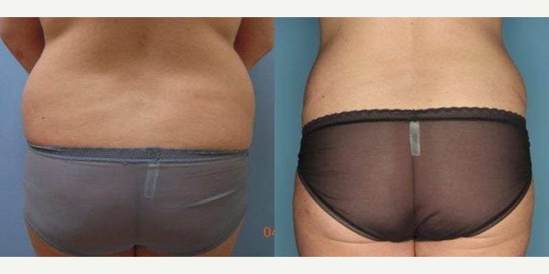 Skin Tightening procedure image