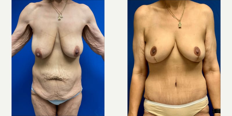 Mommy Makeover procedure image