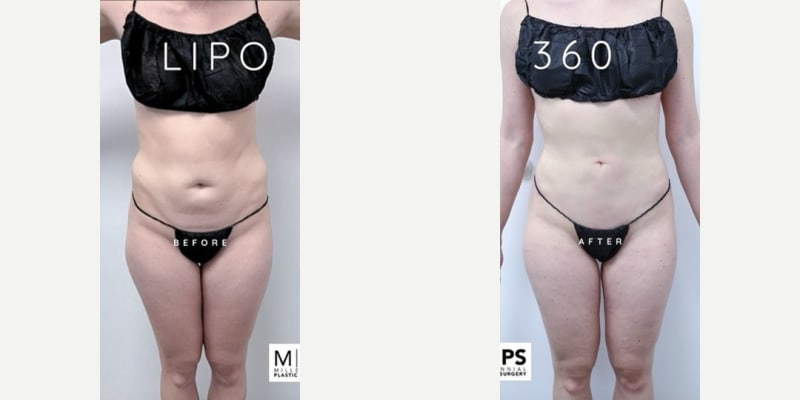 Mommy Makeover procedure image