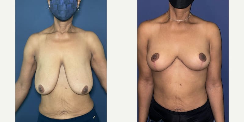 Breast Augmentation procedure image