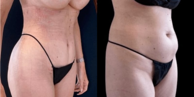 Mommy Makeover procedure image