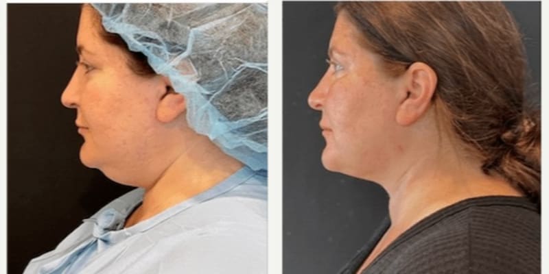 Skin Tightening procedure image