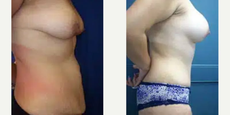 Mommy Makeover procedure image