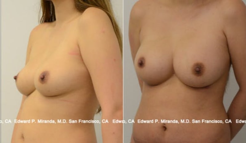 Breast Augmentation procedure image
