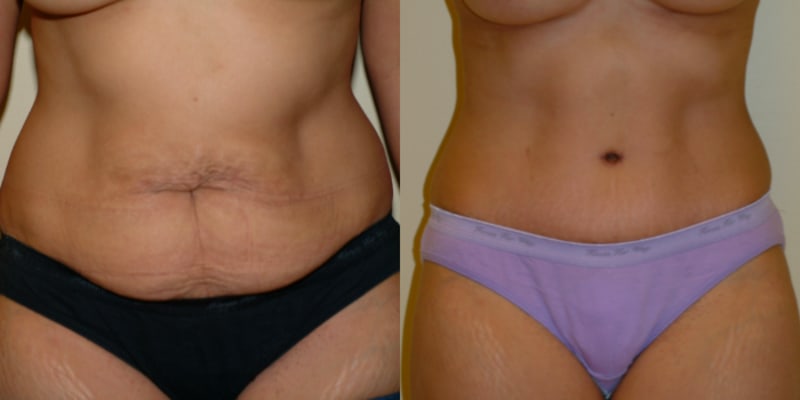 Mommy Makeover procedure image