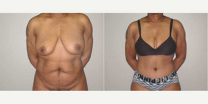 Mommy Makeover procedure image