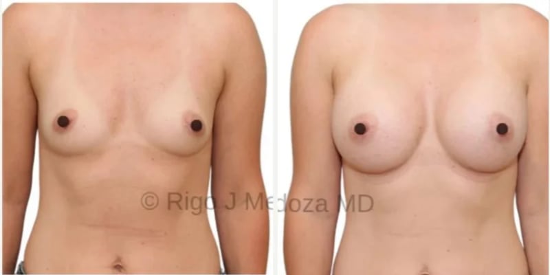 Mommy Makeover procedure image