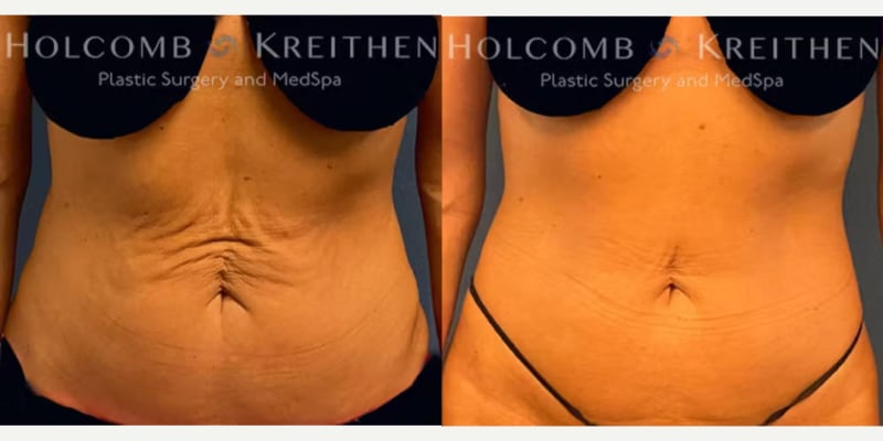 Mommy Makeover procedure image