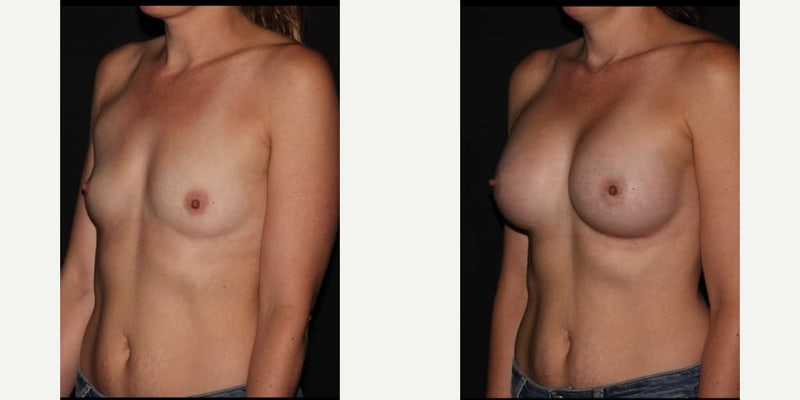 Mommy Makeover procedure image