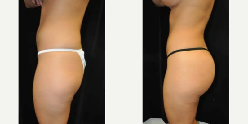 Body Lift procedure image