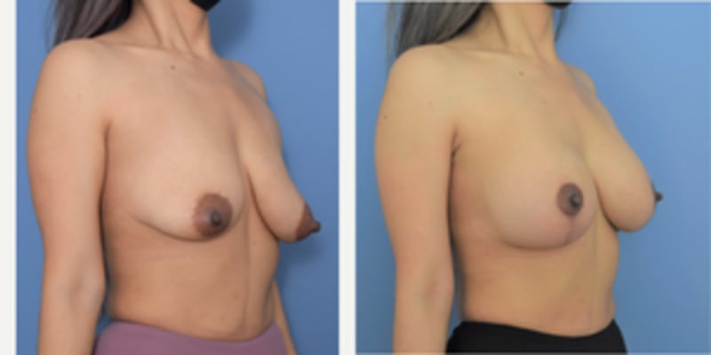 Mommy Makeover procedure image