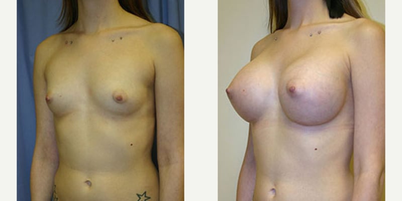Breast Augmentation procedure image