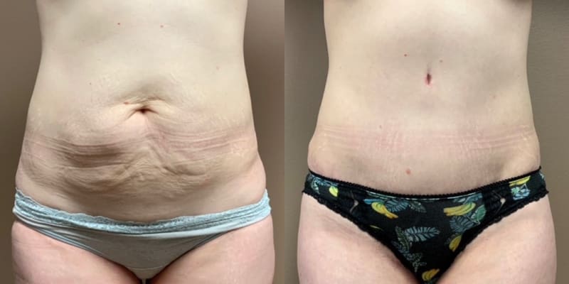 Tummy Tuck (Abdominoplasty) procedure image