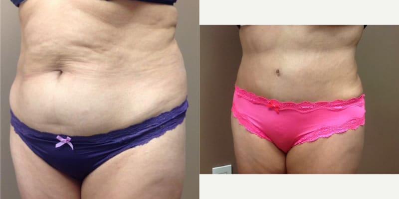 Mommy Makeover procedure image