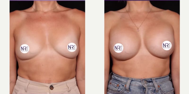 Mommy Makeover procedure image