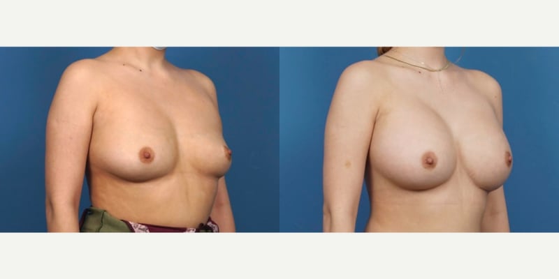 Mommy Makeover procedure image