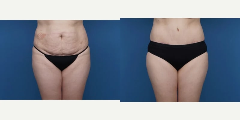 Tummy Tuck (Abdominoplasty) procedure image