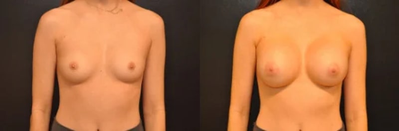 Breast Augmentation procedure image
