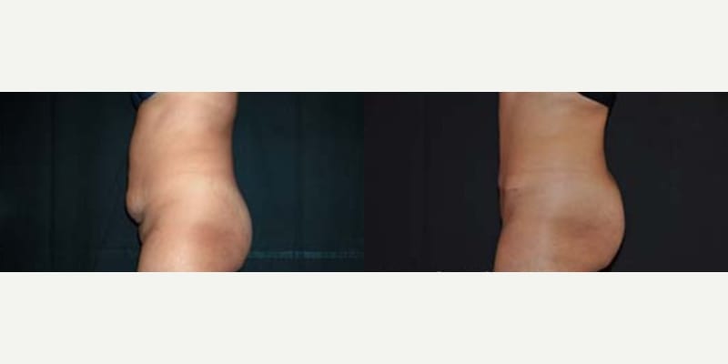 Tummy Tuck (Abdominoplasty) procedure image