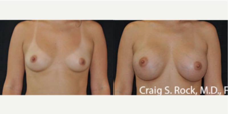 Mommy Makeover procedure image