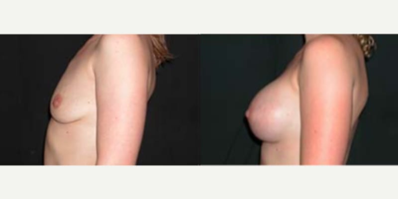 Breast Augmentation procedure image