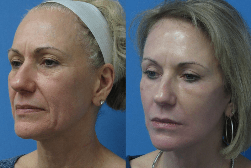 Facelift procedure image