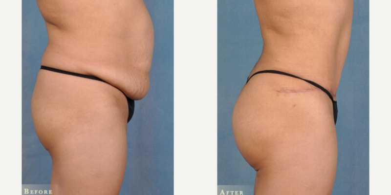 Skin Tightening procedure image