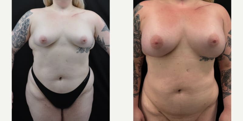 Breast Augmentation with Lift procedure image