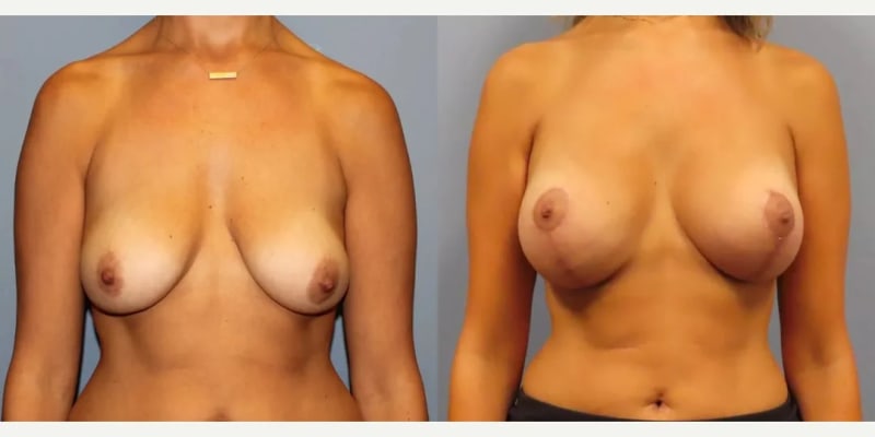 Breast Reduction (Mammoplasty) procedure image
