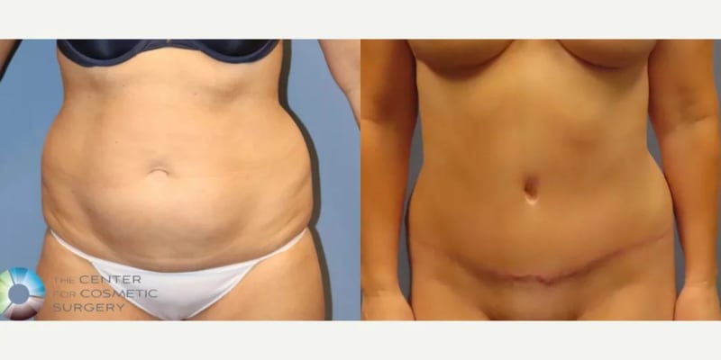 Tummy Tuck (Abdominoplasty) procedure image