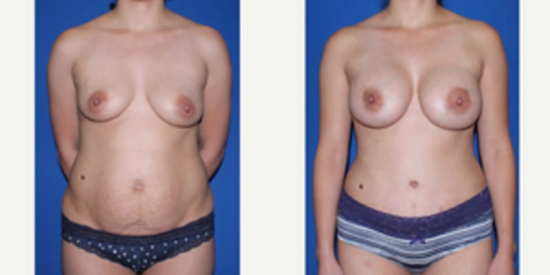 Mommy Makeover procedure image