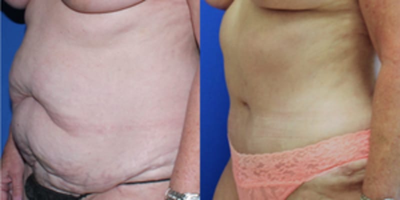 Skin Tightening procedure image