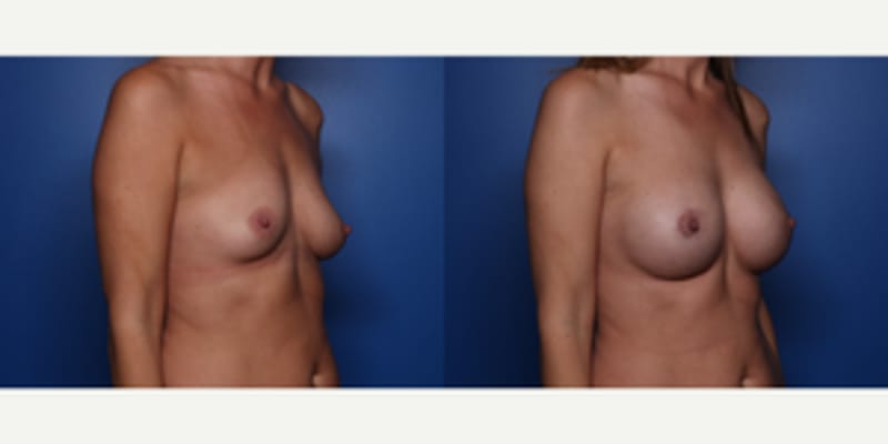 Breast Augmentation procedure image