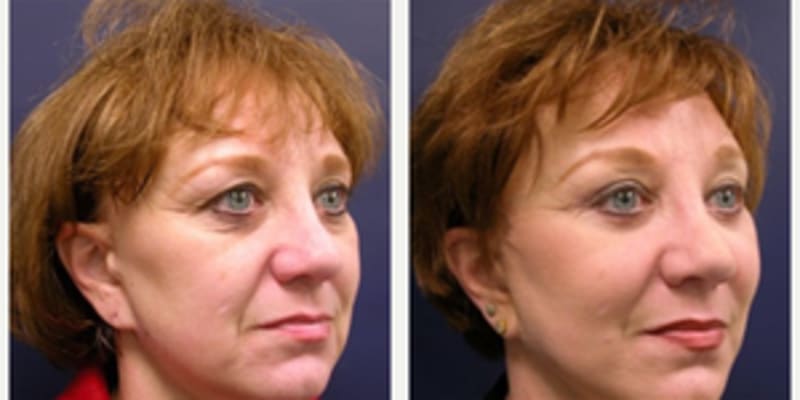 Eyelid Surgery (Blepharoplasty) procedure image