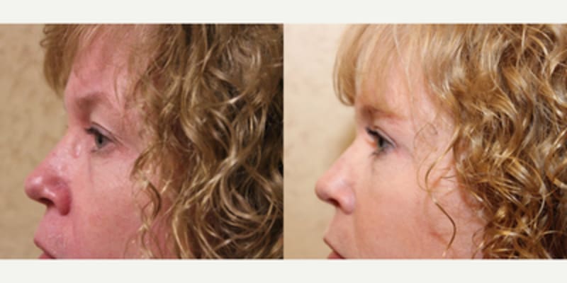 Eyelid Surgery (Blepharoplasty) procedure image