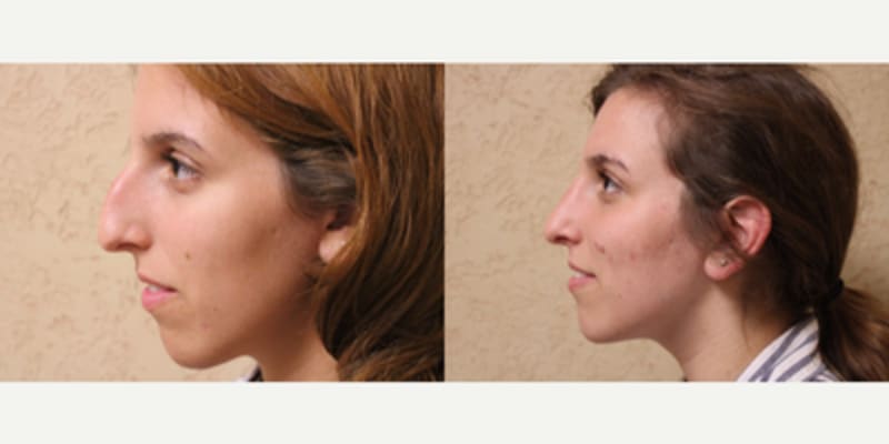 Rhinoplasty (Nose Job) procedure image