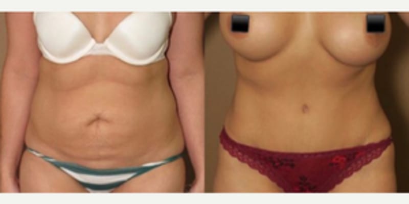 Mommy Makeover procedure image