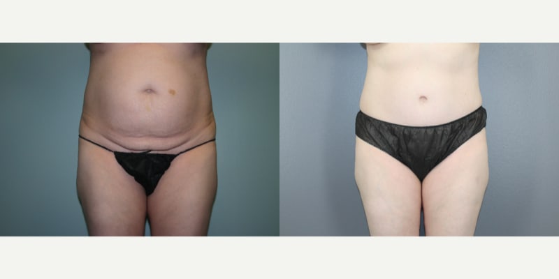 Skin Tightening procedure image