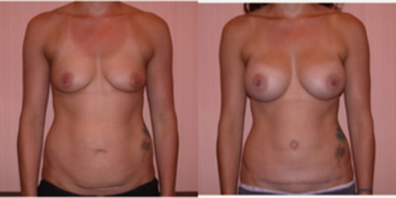 Mommy Makeover procedure image