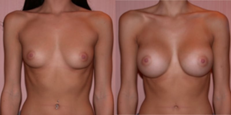 Breast Augmentation procedure image