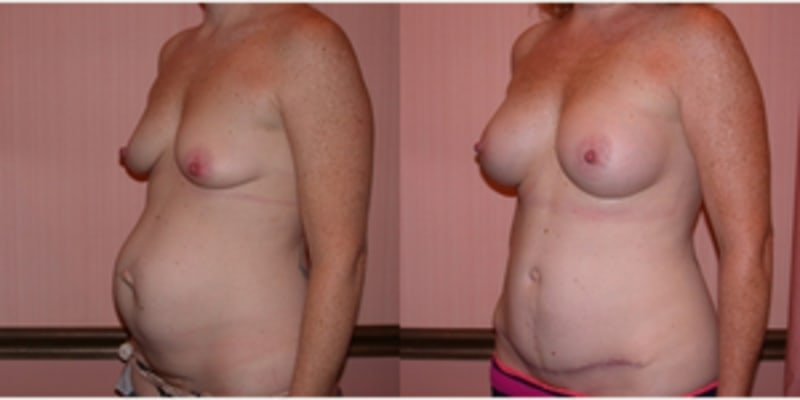 Tummy Tuck (Abdominoplasty) procedure image