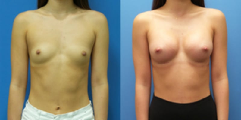 Breast Augmentation procedure image