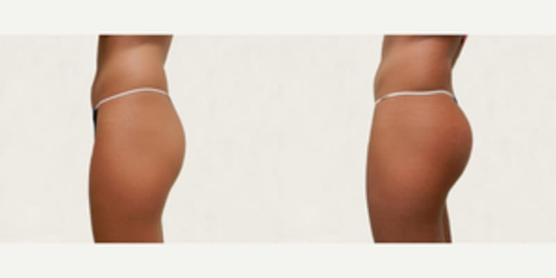 Brazilian Butt Lift (BBL) procedure image