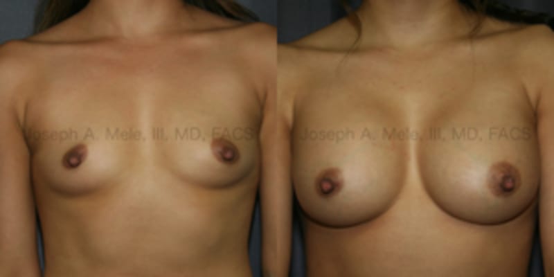 Breast Augmentation procedure image