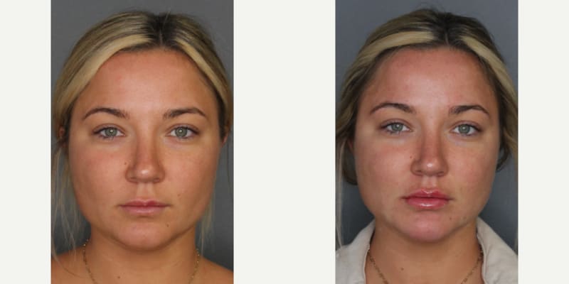 Fillers & Injectables (e.g. Botox, Juvederm) procedure image