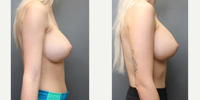 Breast Augmentation procedure image
