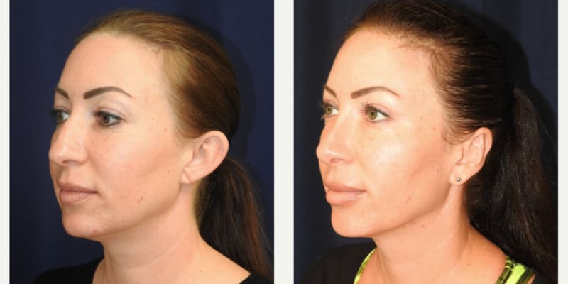 Rhinoplasty (Nose Job) procedure image