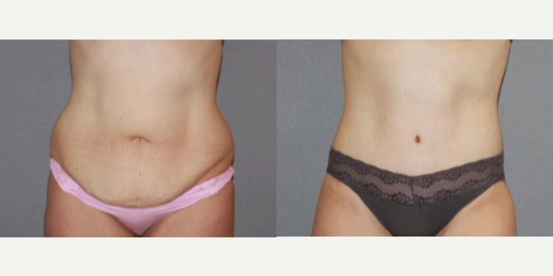 Skin Tightening procedure image