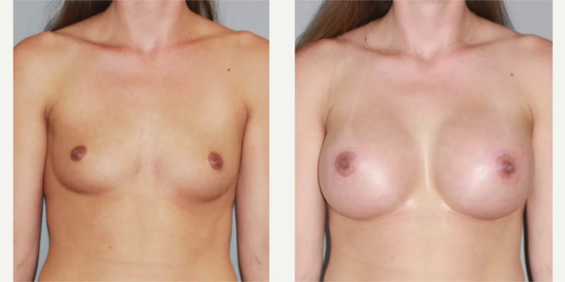 Breast Augmentation procedure image